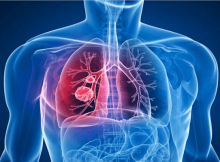 Sintomas da Tuberculose | Preço de Convênio Médico