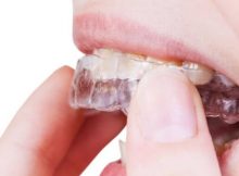 O Que é Bruxismo Dentário | Preço de Convênio Médico