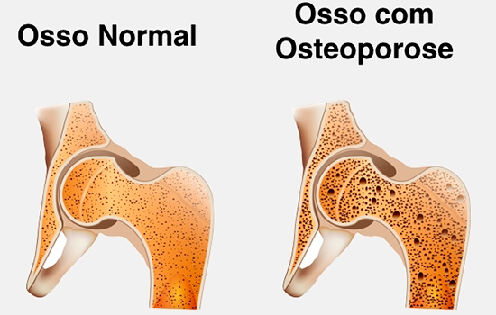 9 Sintomas de Osteoporose 