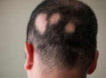 alopecia