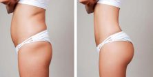Quanto custa uma lipoescultura